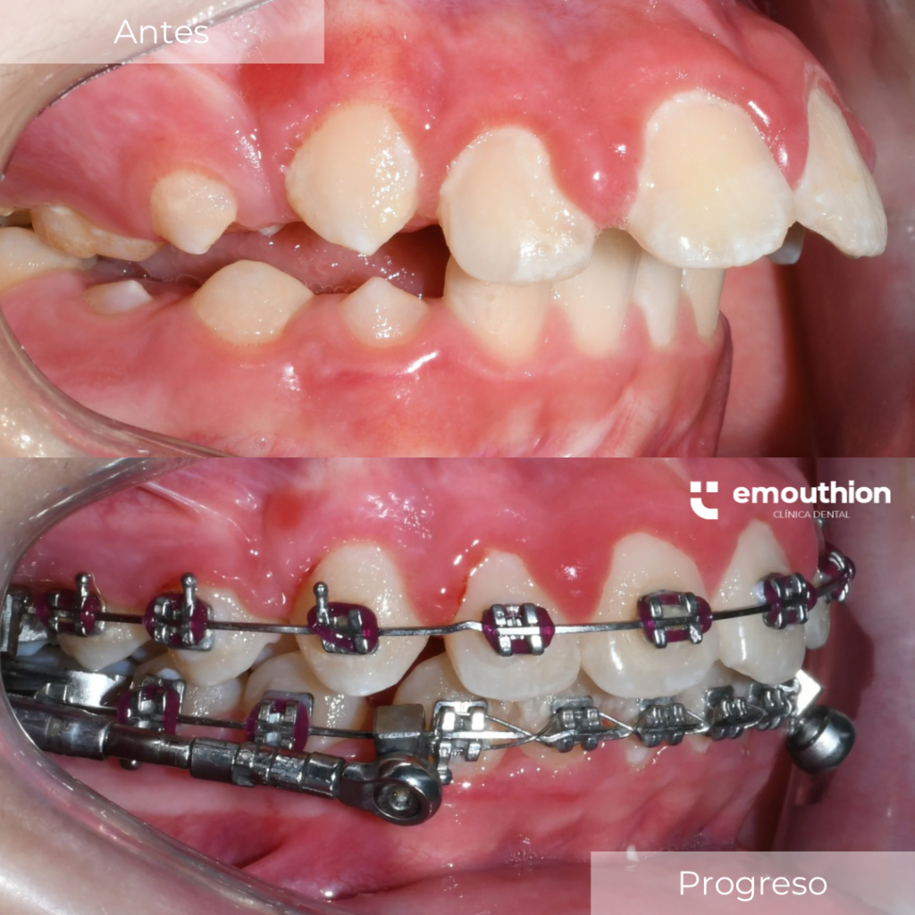 tratamiento ortopedia, ortodoncia, brackets, lima, especialista powerscope