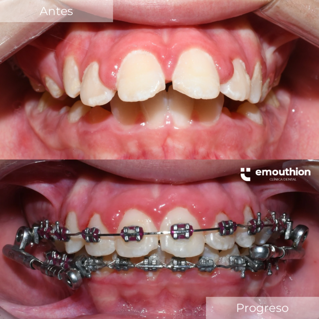 tratamiento ortopedia, ortodoncia, brackets, lima, especialista powerscope