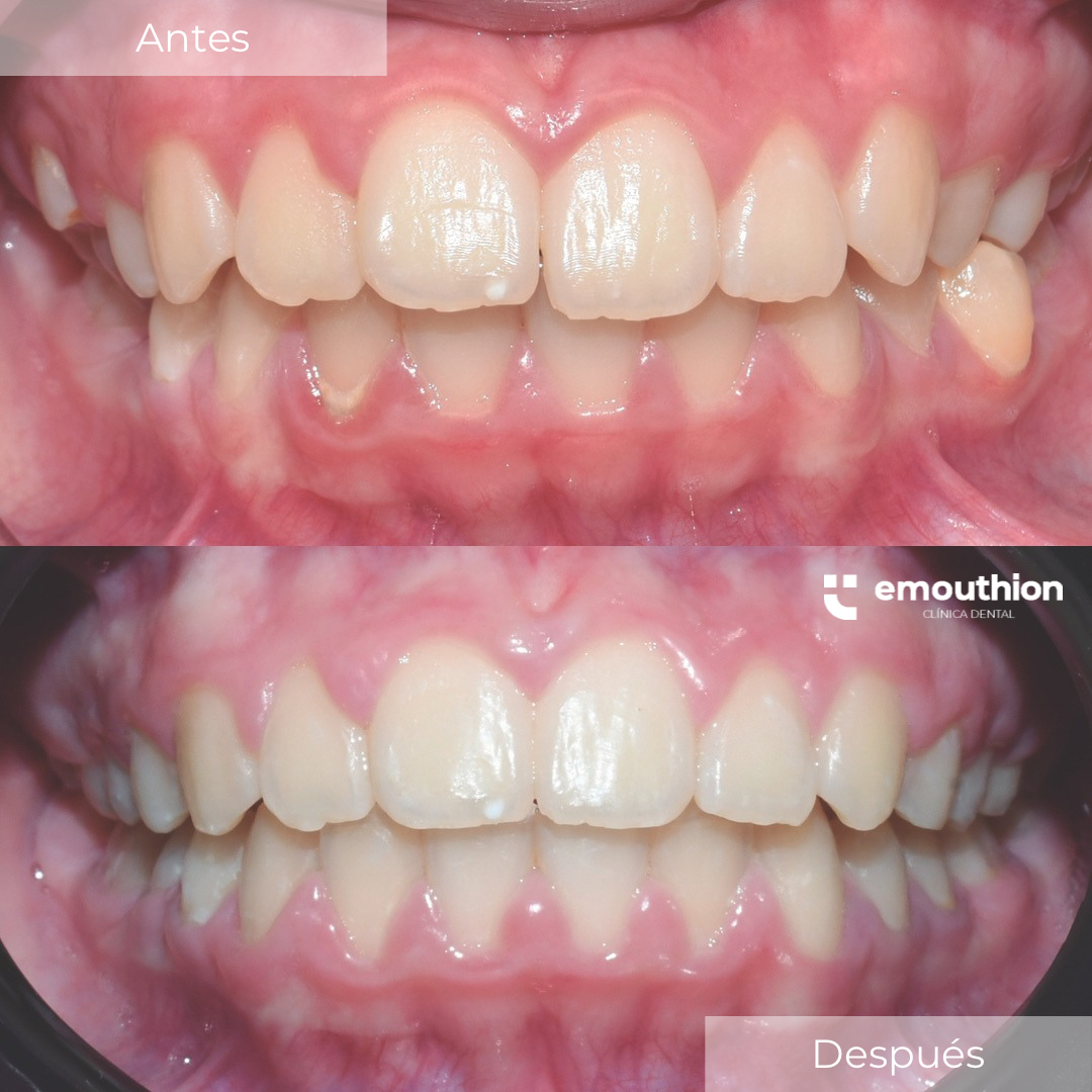 tratatamiento de ortodoncia, brackets, especialista, lima dentista