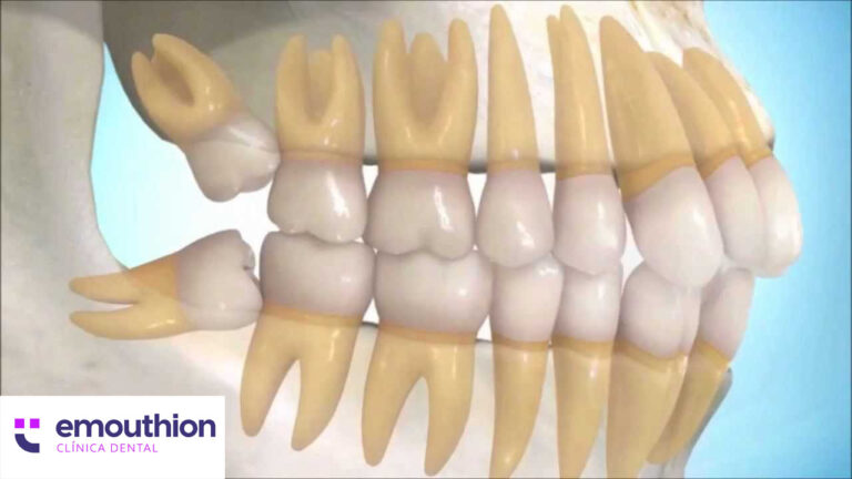 muelas del juicio, extracción, cirugía maxilofacial, lima