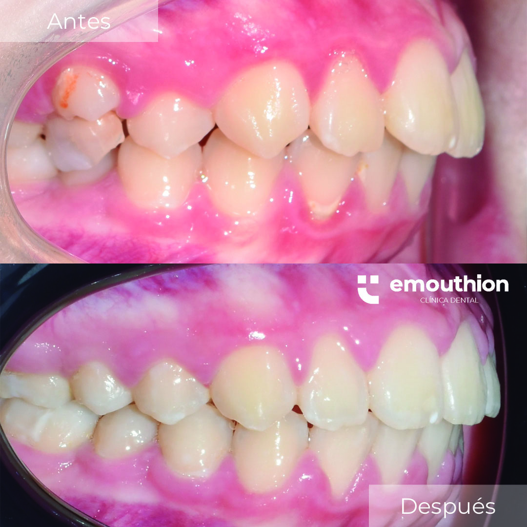 maloclusion clase I brackets emouthion