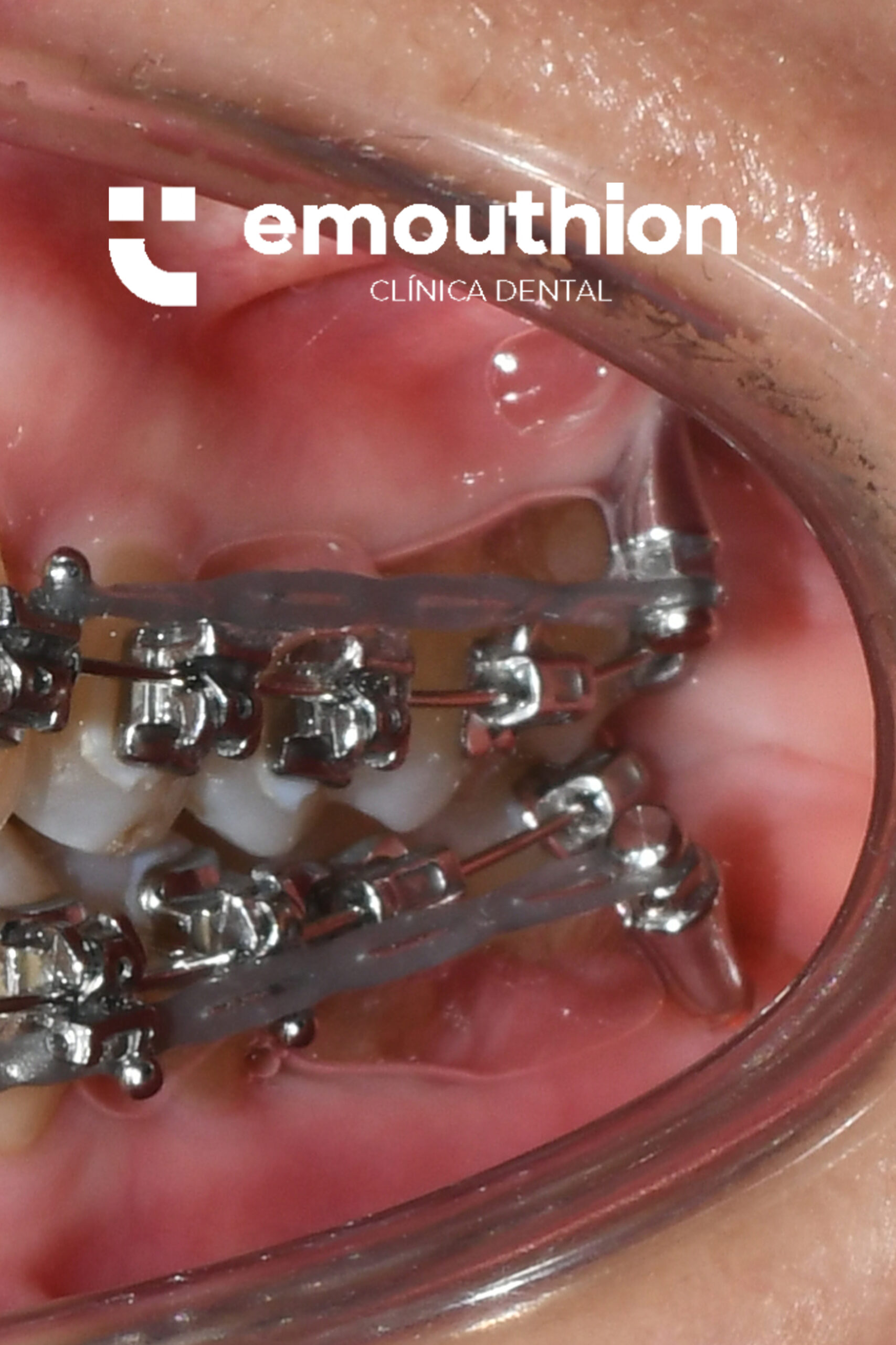 MINITORNILLO EXTRAALVEOLAR MINISCREW ORTODONCIA LIMA BRACKETS