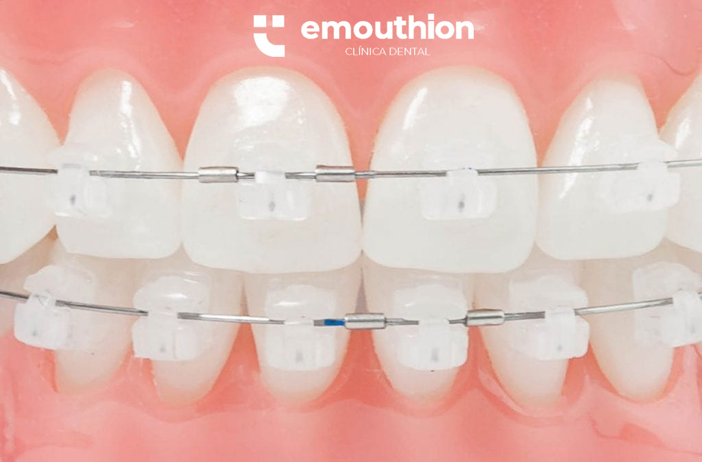 brackets-autoligado.esteticos-emouthion.dentista-ortodoncia-lima