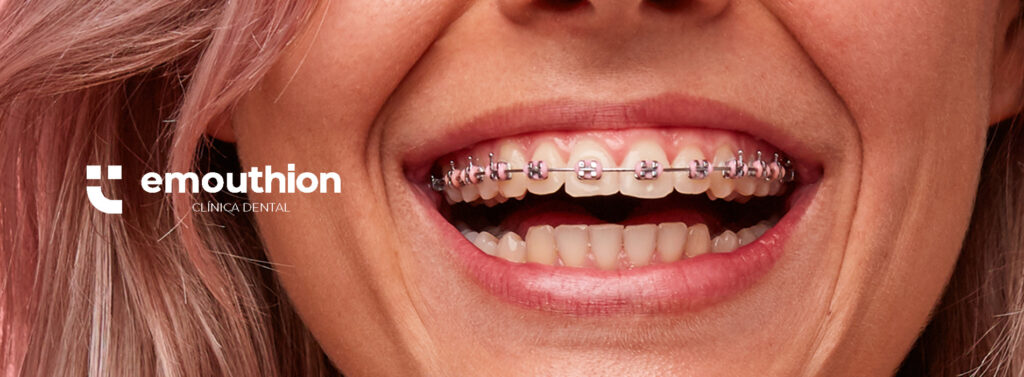 brackets-convencionales-ortodoncia-dentista-lima