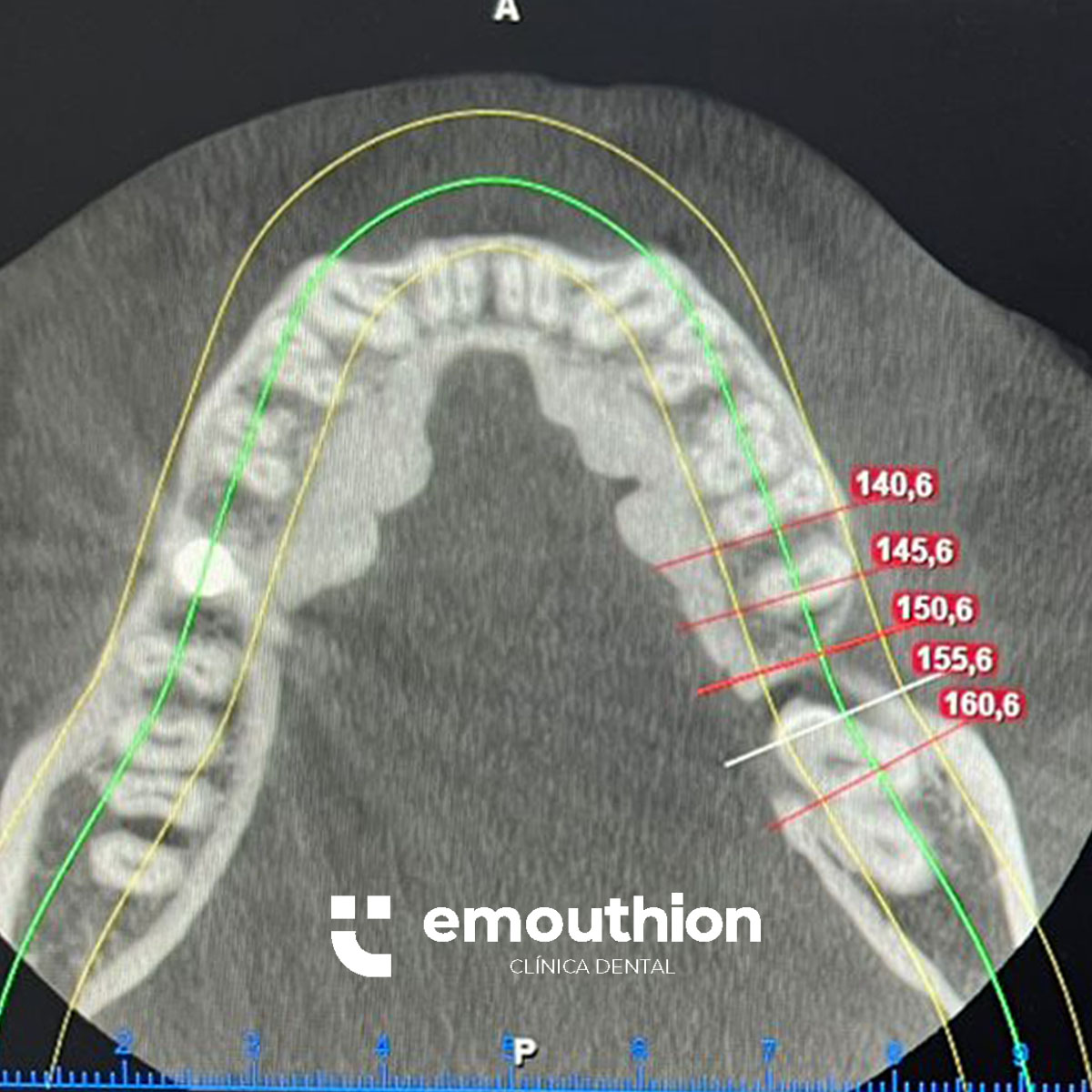 tomografia emouthion implante dental dentista lima