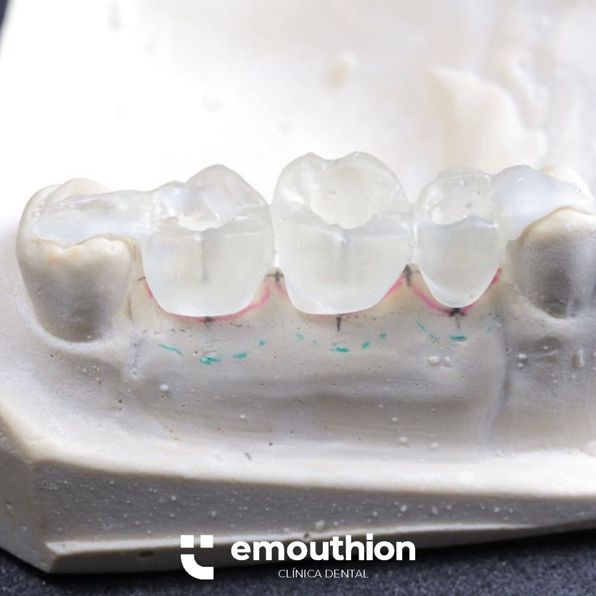 guia de insercion implante emouthion dentista lima