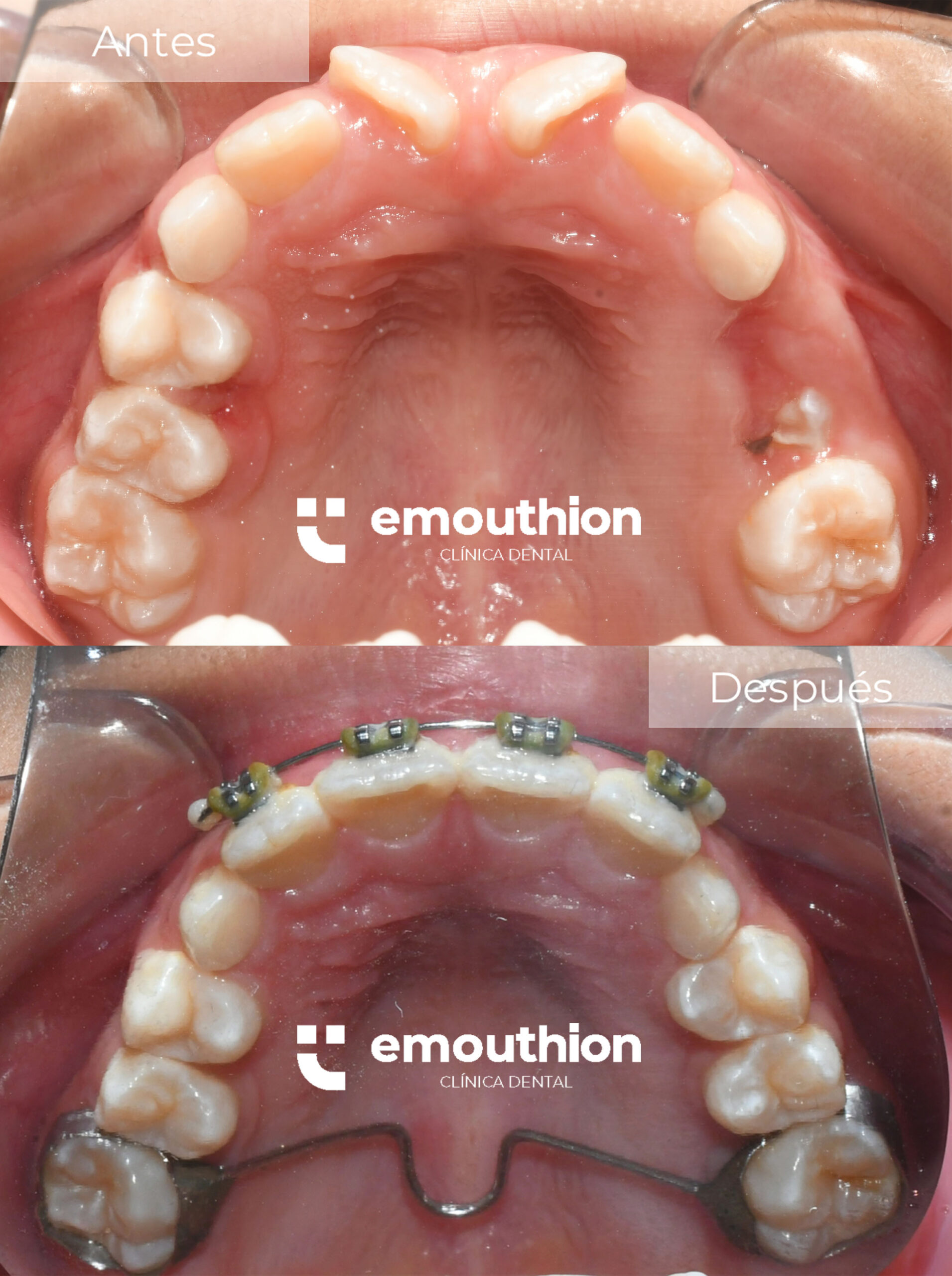 ortodoncia-interceptiva-brackets-emouthion-lima